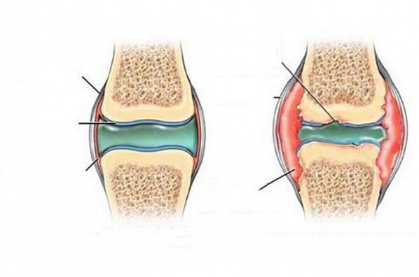Quá trình biến dạng của khớp