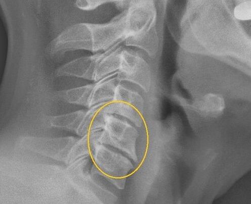 Xơ xương của cột sống cổ trên một x -ray