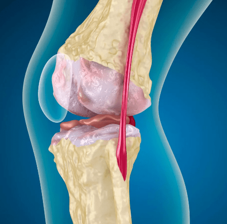 Arthrososis của khớp gối