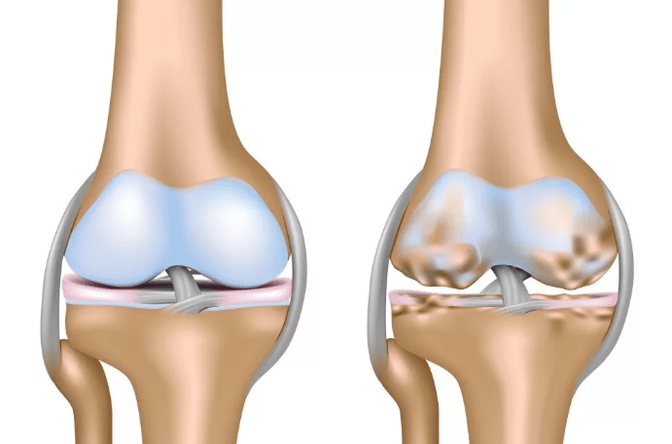 Biến dạng khớp của khớp gối