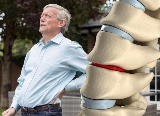 Thoái hóa khớp ảnh hưởng đến đĩa đệm và gây đau lưng